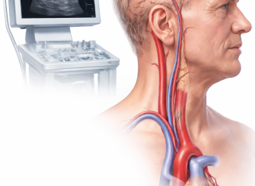 Carotid Artery Stenosis: What it means and how to prevent a stroke